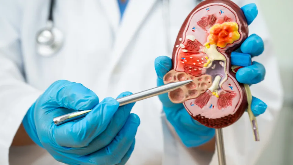 Pedra nos rins aumentam até 30% durante o verão